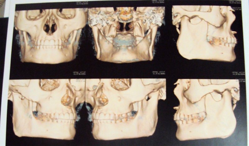 Woman with perfect square jaw - CT scan